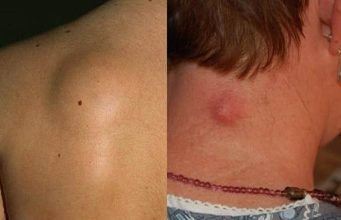 Šta su LIPOMI i da li su opasni? Evo kada je neophodno njihovo uklanjanje