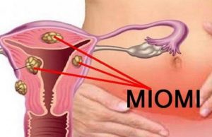 Mnoge žene nisu svjesne da ga imaju: 6 SIMPTOMA MIOMA MATERNICE