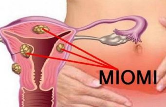 Mnoge žene nisu svjesne da ga imaju: 6 SIMPTOMA MIOMA MATERNICE