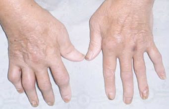 HRANA KOJA UNIŠTAVA VAŠE KOSTI: Izbjegavajte ove namirnice ako želite da ostanete jaki i zdravi