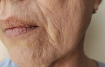 Dva neobična simptoma u ustima otkrivaju manjak vitamina B12